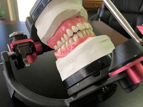 Bite Registration Determination Image of Bite Registration Determination