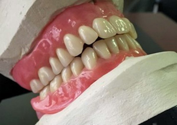 Customized Wax Denture Set-Up Image of Customized Wax Denture Set-Up
