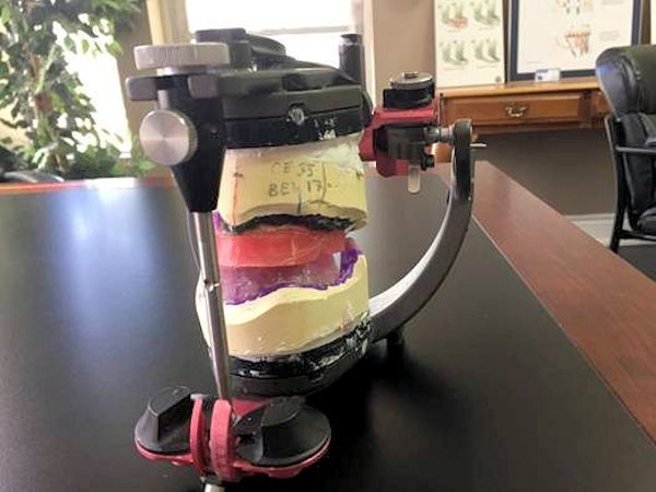 Facebow Transfer Image of Facebow Transfer