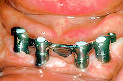 Image of denture bar secured to denture abutments