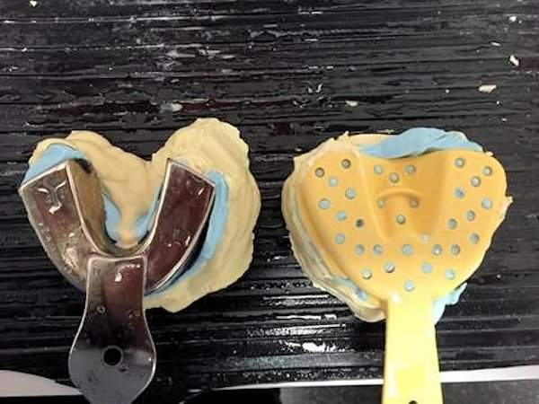 Preliminary Denture Impression Image of Preliminary Denture Impression