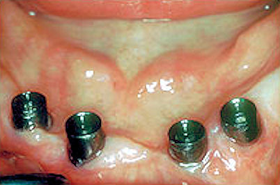 Image of standard abutments connected to the tops of the implants